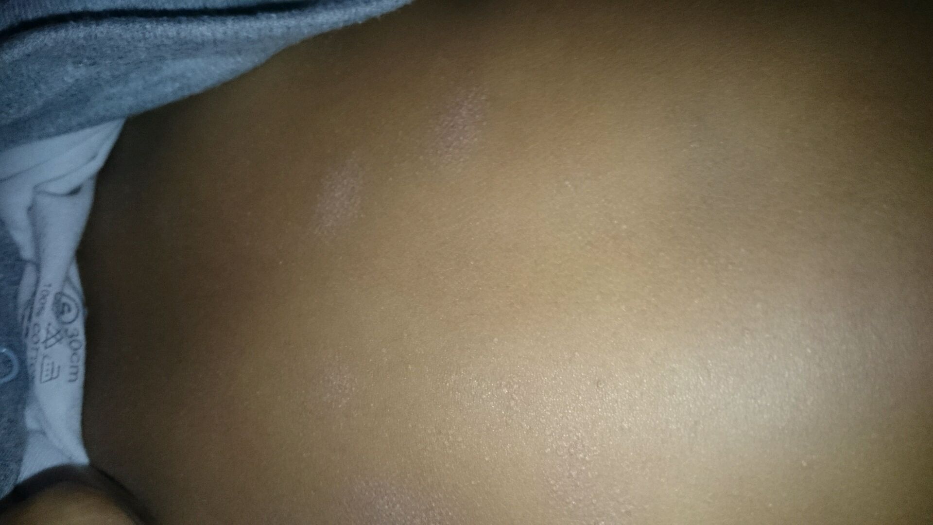 Hello doctor. my baby is 6 month old and she has rashes