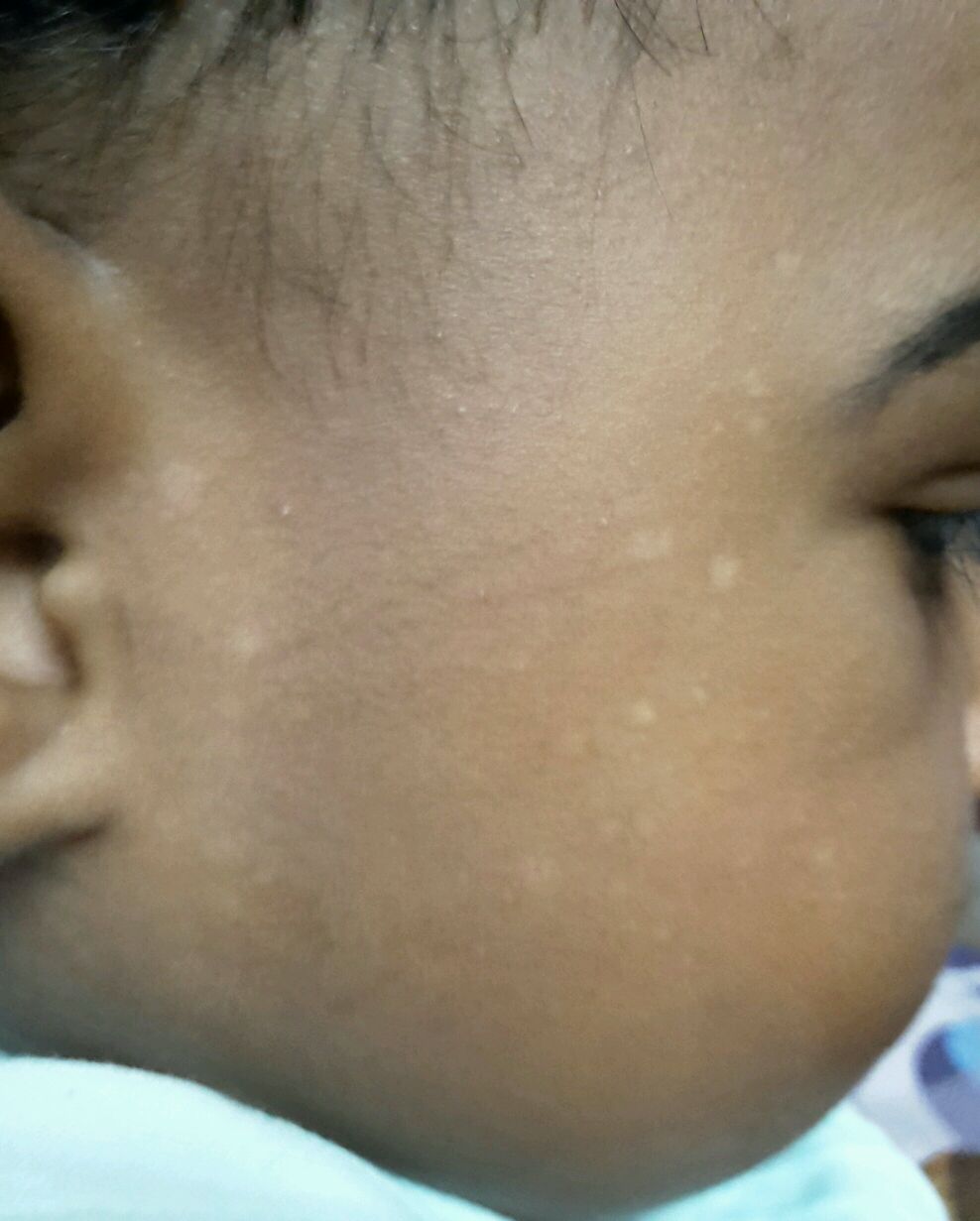 my baby 8months is white spots on her face what light spots on baby face